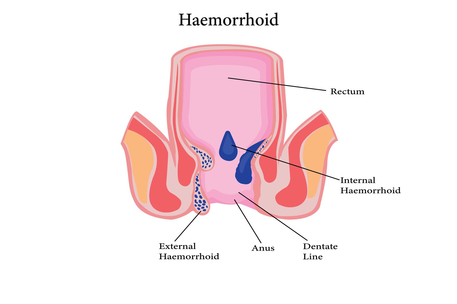 Illustration of the types of hemorrhoids