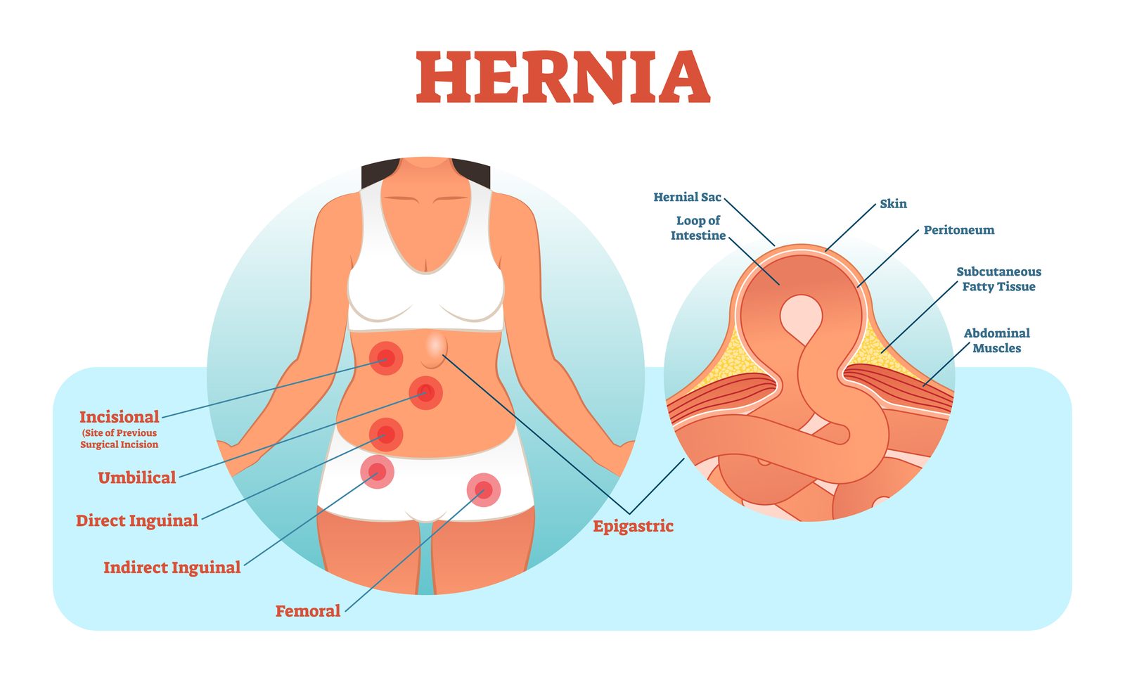 Illustration of the common types of abdominal and groin hernias