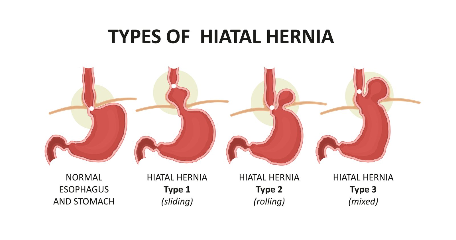 Illustration of the types of hiatal hernia, where the stomach pushes up through the diaphragm